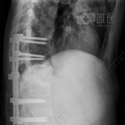强直性脊柱炎手术视频,技术要点与康复指导
